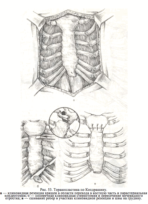 торакопластика по кондрашину