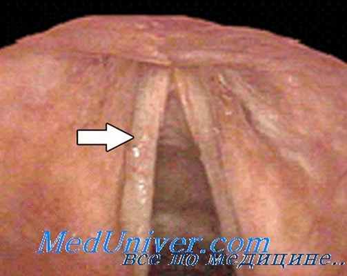 паралич гортани