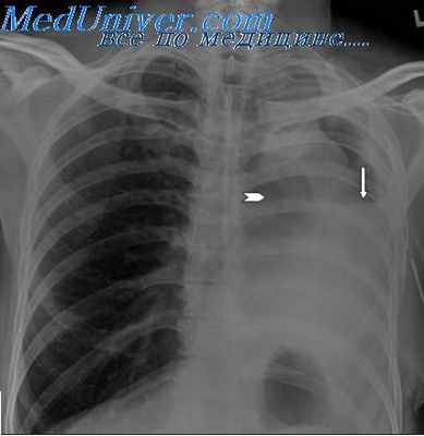 бронхо-плевральные свищи