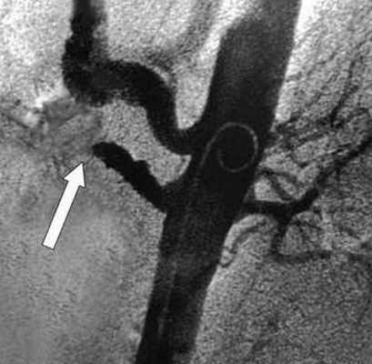 Ангиография позволяет поставить точный диагноз и выполнить вмешательство по восстановлению кровообращения