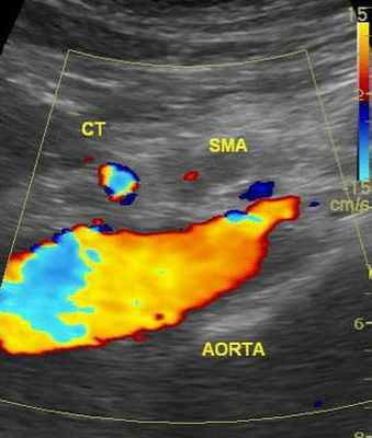 УЗИ картина закупорки верхней брыжеечной артерии