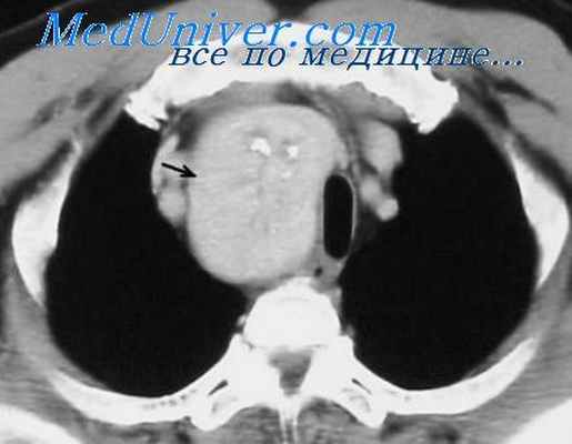 внутригрудной зоб