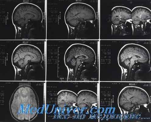 черепно-мозговые травмы