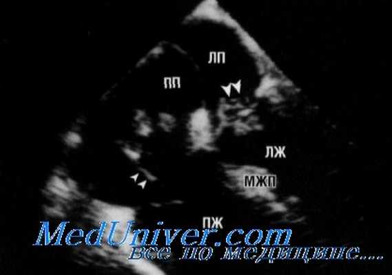 чреспищеводная эхокардиография