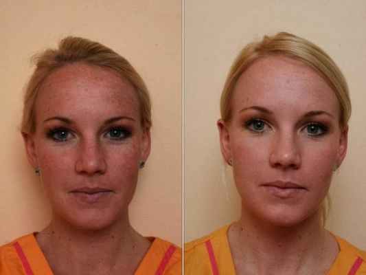 Эффект от сеансов криомассажа жидким азотом