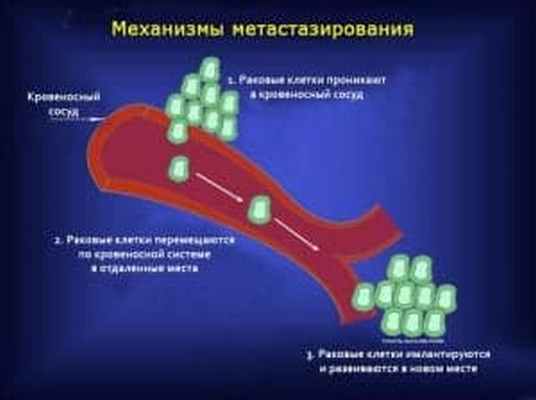 Механизмы метастазирования опухолей