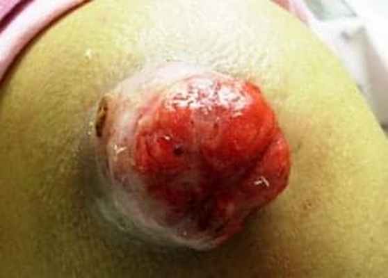 Грибовидный метастаз рака легких в кожу плеча