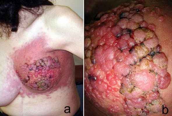 Метастазы в кожу, первичная опухоль - аденокарцинома желудка