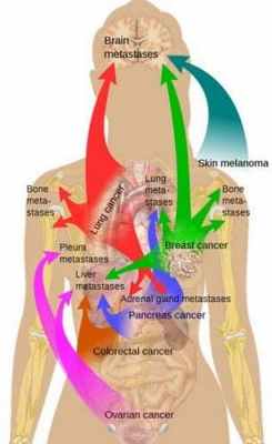 Типичные пути метастазирования