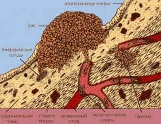 Типичные пути метастазирования опухолей