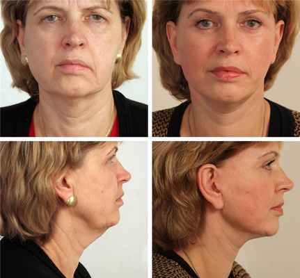 Подтяжка шеи