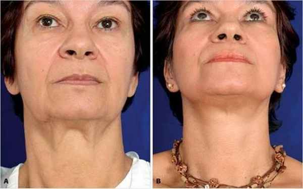 платизмопластика в Москве