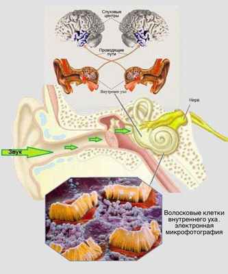 Слуховая нейропатия