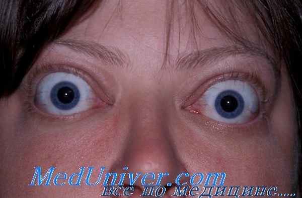 эндокринная офтальмопатия