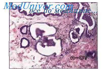 бронхоэктатическая болезнь