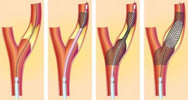 Эндоваскулярный метод лечения