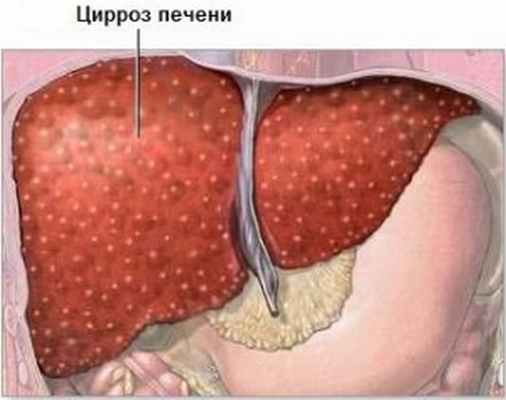 Диагностика цирроза печени - медцентр 