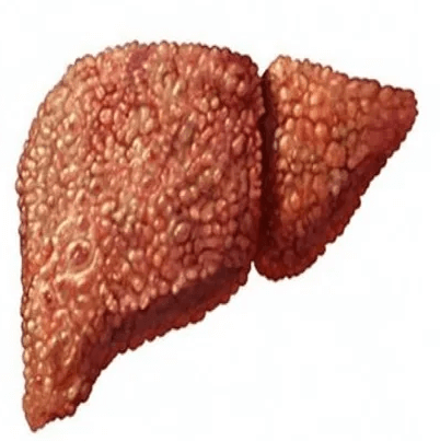 Цирроз печени