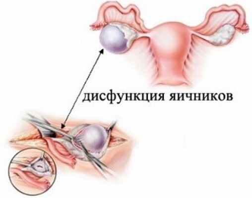 Дисфункция яичников - медцентр 