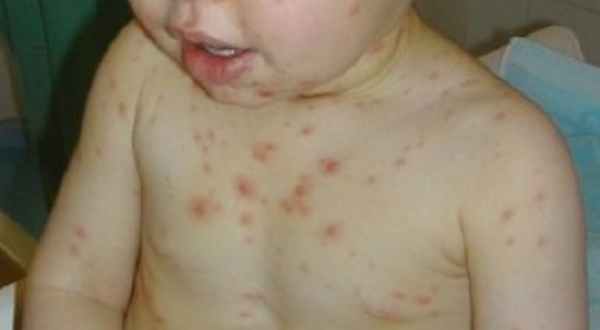 Острый лимфобластный лейкоз