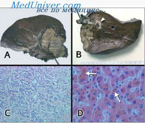 цитология опухоли