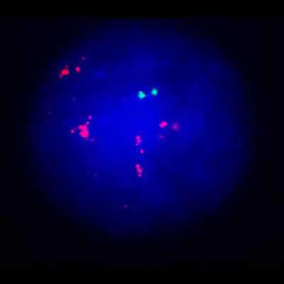 FISH метод - амплификация гена HER2/NEU в клетках рака молочной железы