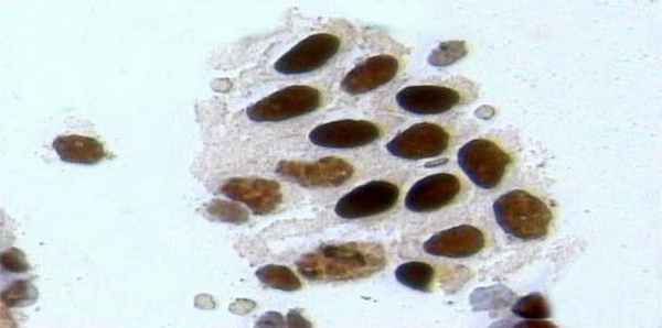 Экспрессия рецепторов эстрогенов в клетках рака молочной железы