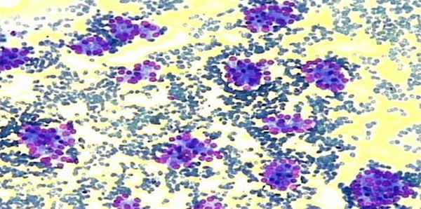 Фолликулярный рак щитовидной железы