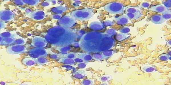 Эпителиоклеточная пигментная меланома