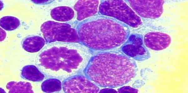 Злокачественная неходжкинская лимфома