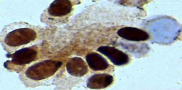 Экспрессия рецепторов прогестерона в клетках рака молочной железы