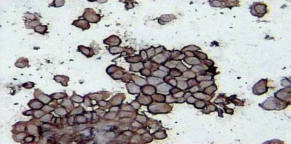 Экспрессия онкопротеина C-erb-B2 в клетках рака