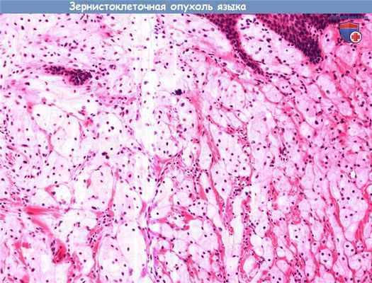 Цитология (гистология) биопсии языка при зернистоклеточном раке