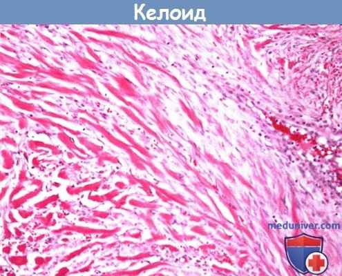 Цитология (гистология) биопсии наружного уха при келоиде