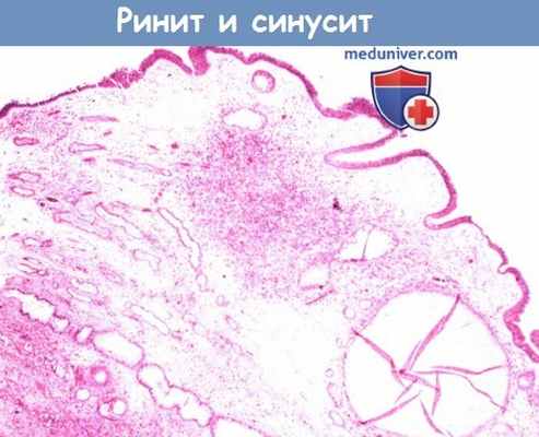 Ринит и синусит