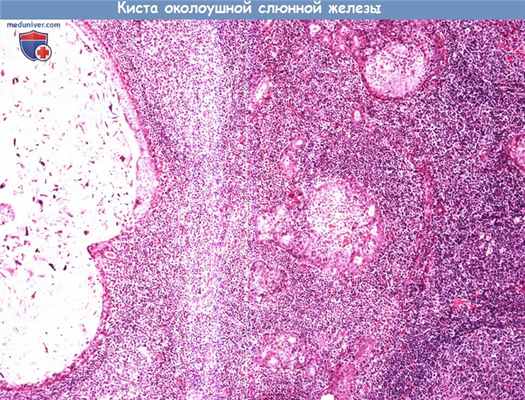 Цитология (гистология) слюнной железы при кисте околоушной слюнной железы