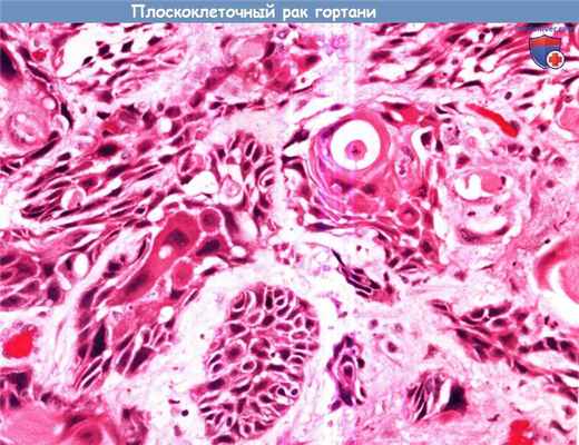 Цитология (гистология) биопсии гортани при плоскоклеточном раке
