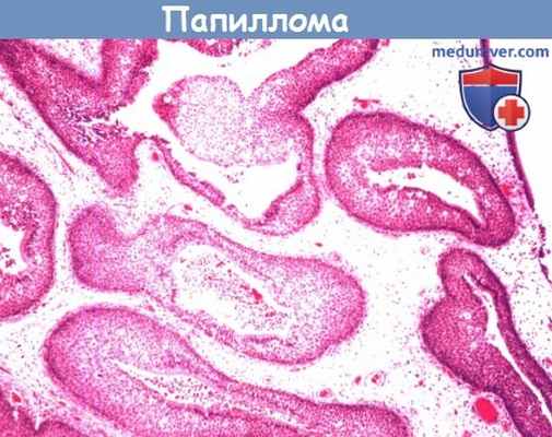 Цитология (гистология) папилломы