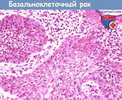 Цитология (гистология) биопсии наружного уха при базальноклеточном раке