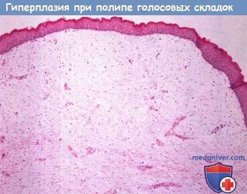 Цитология (гистология) гиперплазии при полипе голосовой складки
