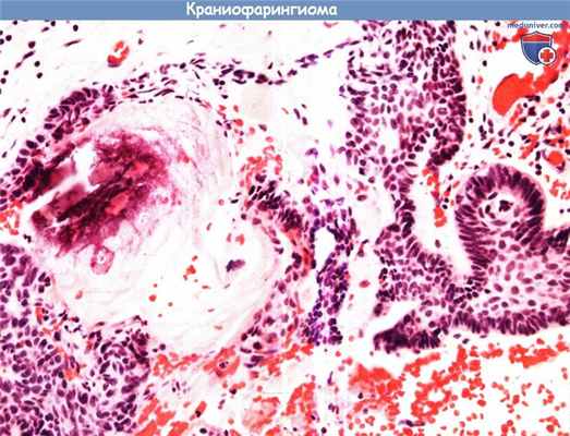 Цитология (гистология) краниофарингиомы