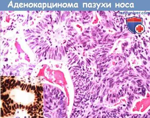 Цитология (гистология) аденокарциномы пазухи носа