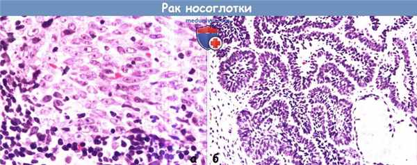 Цитология (гистология) рака носоглотки