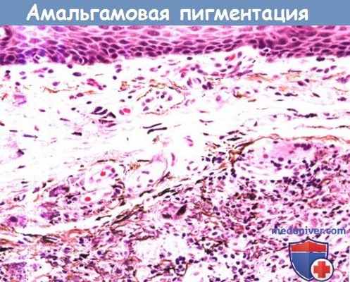 Цитология (гистология) амальгамовой пигментации