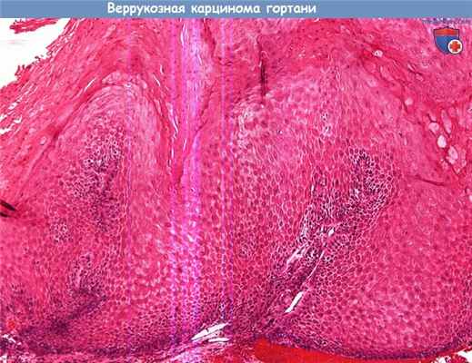 Цитология (гистология) биопсии гортани при веррукозной карциноме