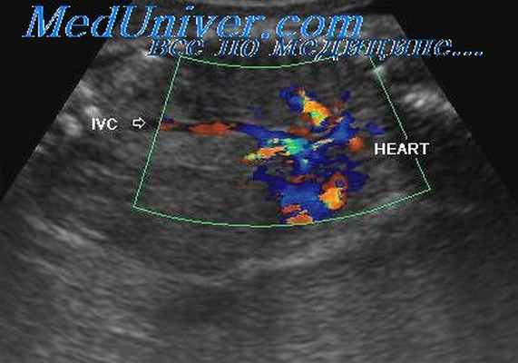 допплерография дыхания плода