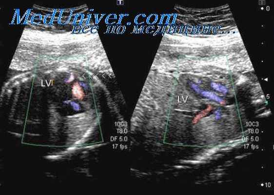 допплерография легочного кровотока