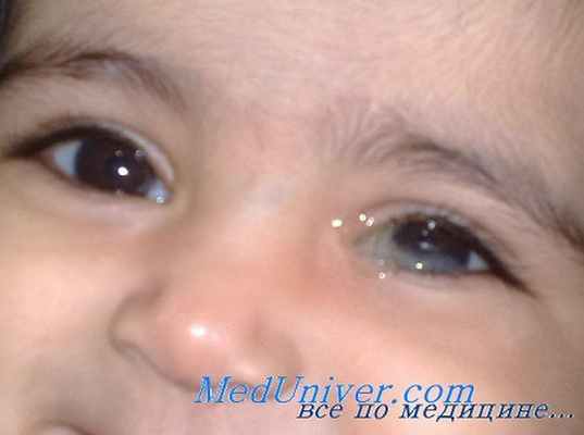 непроходимость носослезного канала