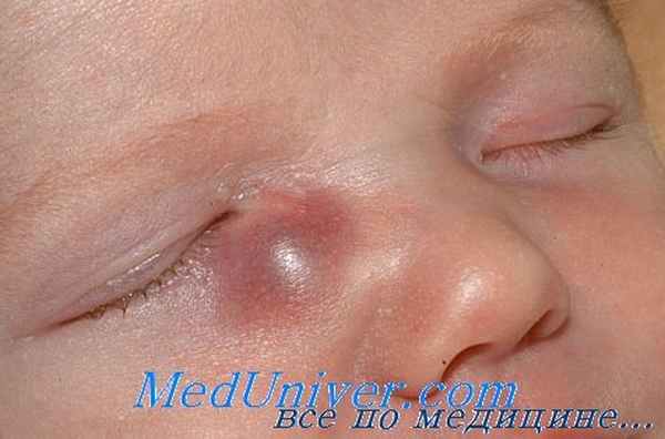 непроходимость носослезного канала - дакриоцистит