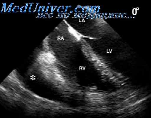 межпредсердная перегородка